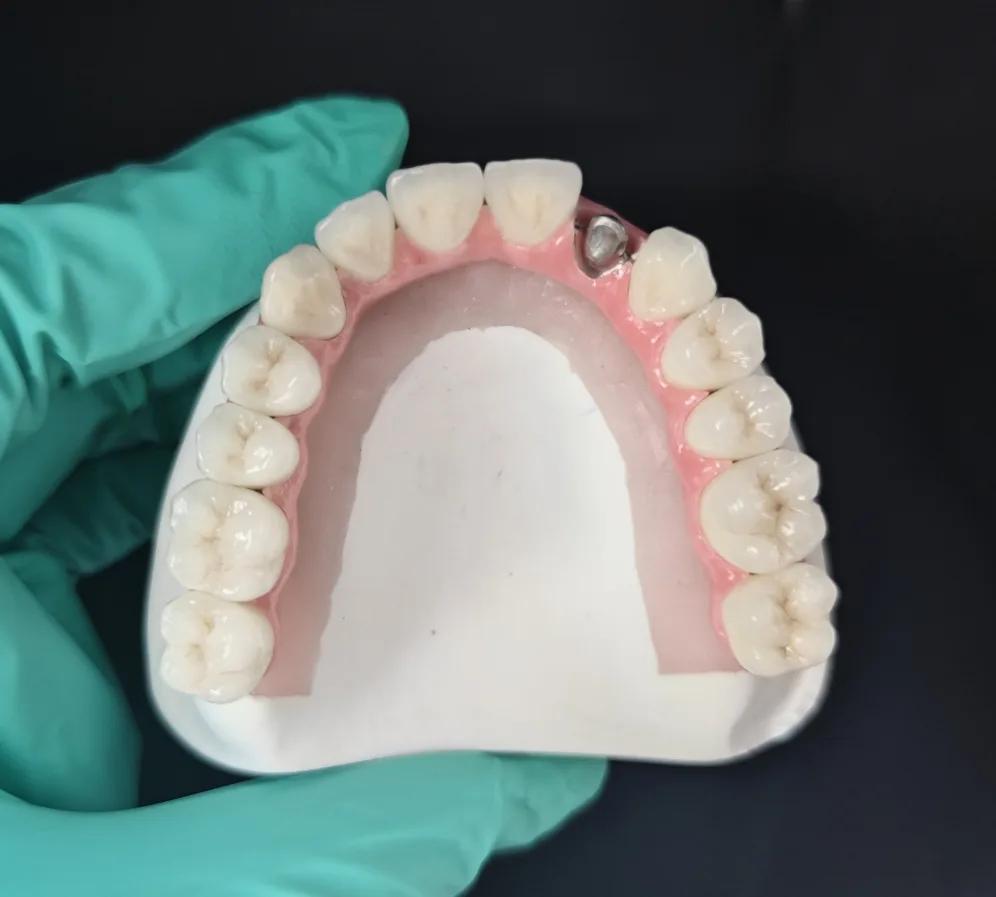 Implant Restorations