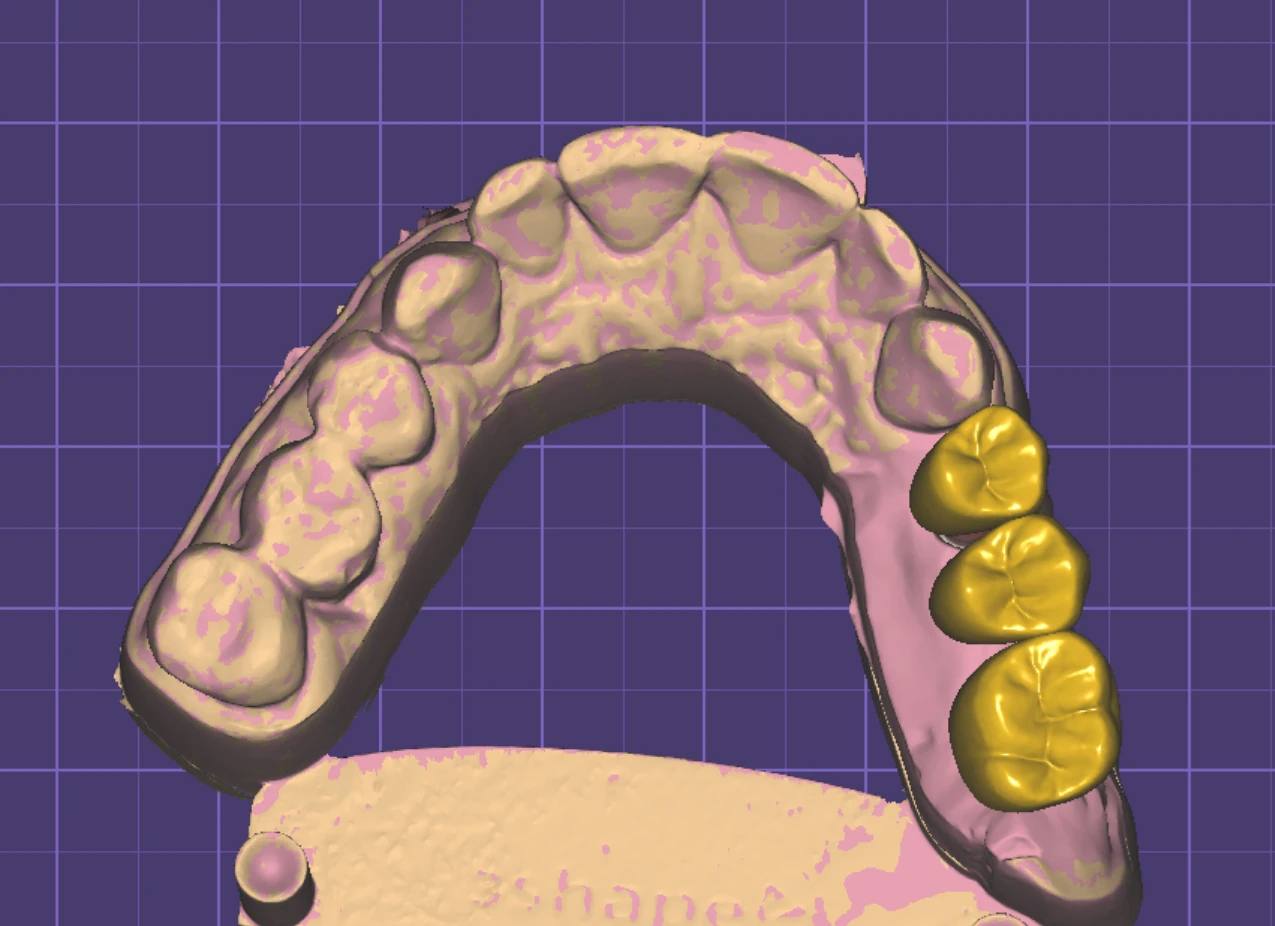 Crown & Bridge Design