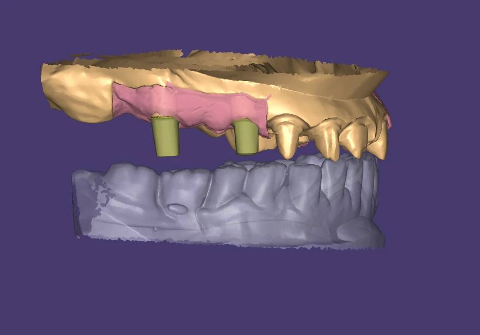 Custom Abutment Design