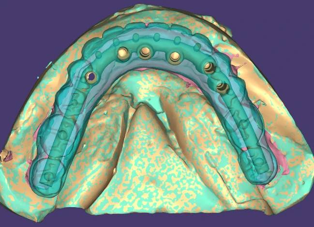 Implant Bar Design