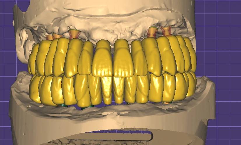 Implant Crown Design