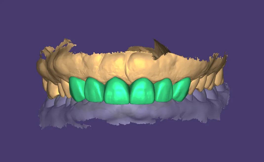 Veneer Design